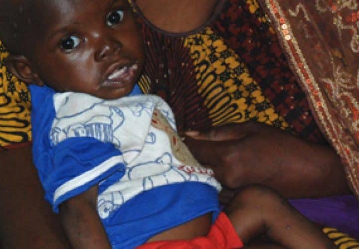 Enfant touché par la malnutrition au Mali, illustrant la crise sanitaire